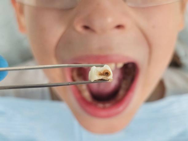 Best Emergency Treatment for Toothache in St David, AZ